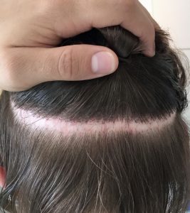 Breitnarbe nach FUT-Haartransplantation