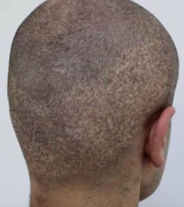 Zerstörter Haarkranz nach verpfuschter FUE - Haartransplantation durch Nichtärzte